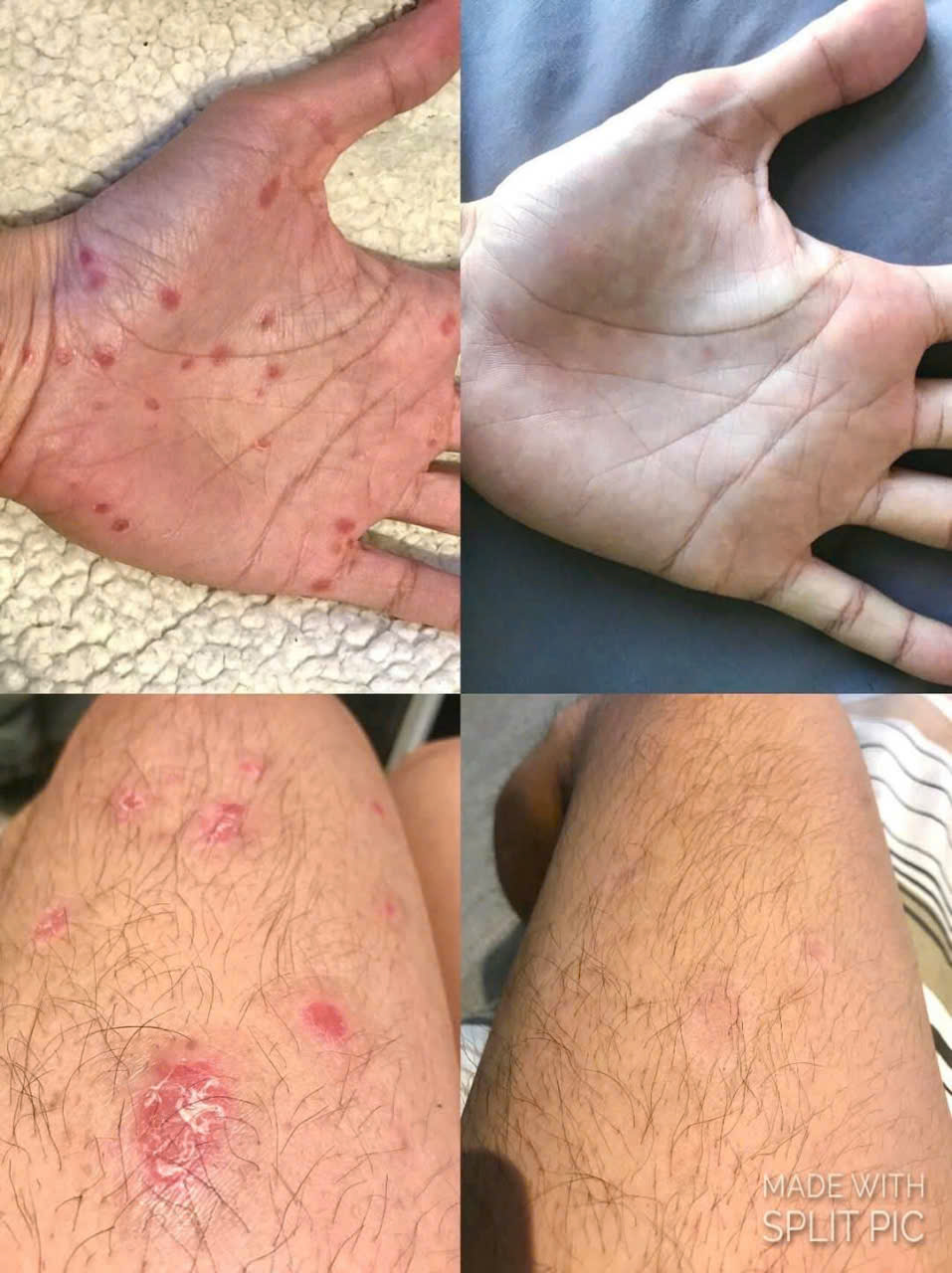 Thuốc Tremfya (Guselkumab): Giải pháp điều trị toàn diện cho bệnh vẩy nến mức độ trung bình đến nặng Bệnh vẩy nến