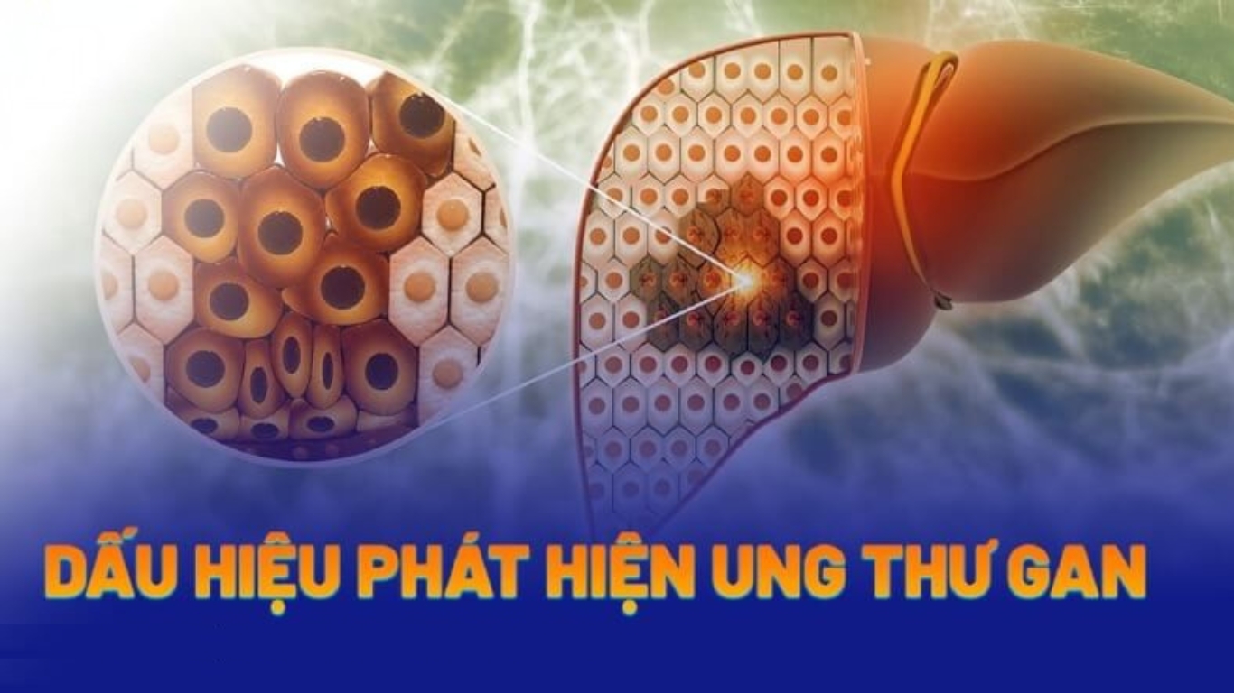 dấu hiệu sớm ung thư gan