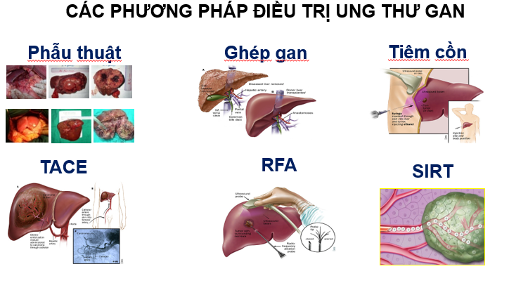 Điều Trị Ung Thư Gan