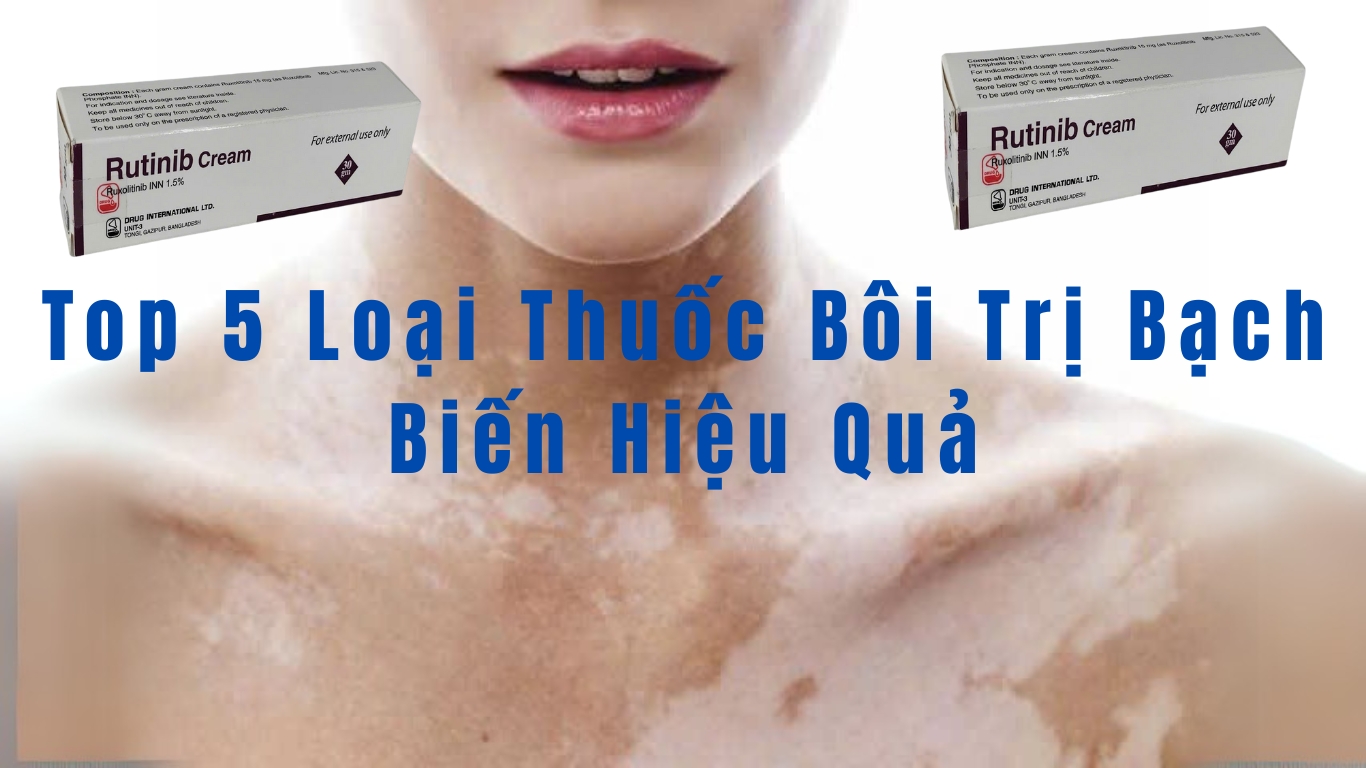 Top 5 Loại Thuốc Bôi Trị Bạch Biến Hiệu Quả Nhất Hiện Nay BACH BIEN VUNG DA TAY 1