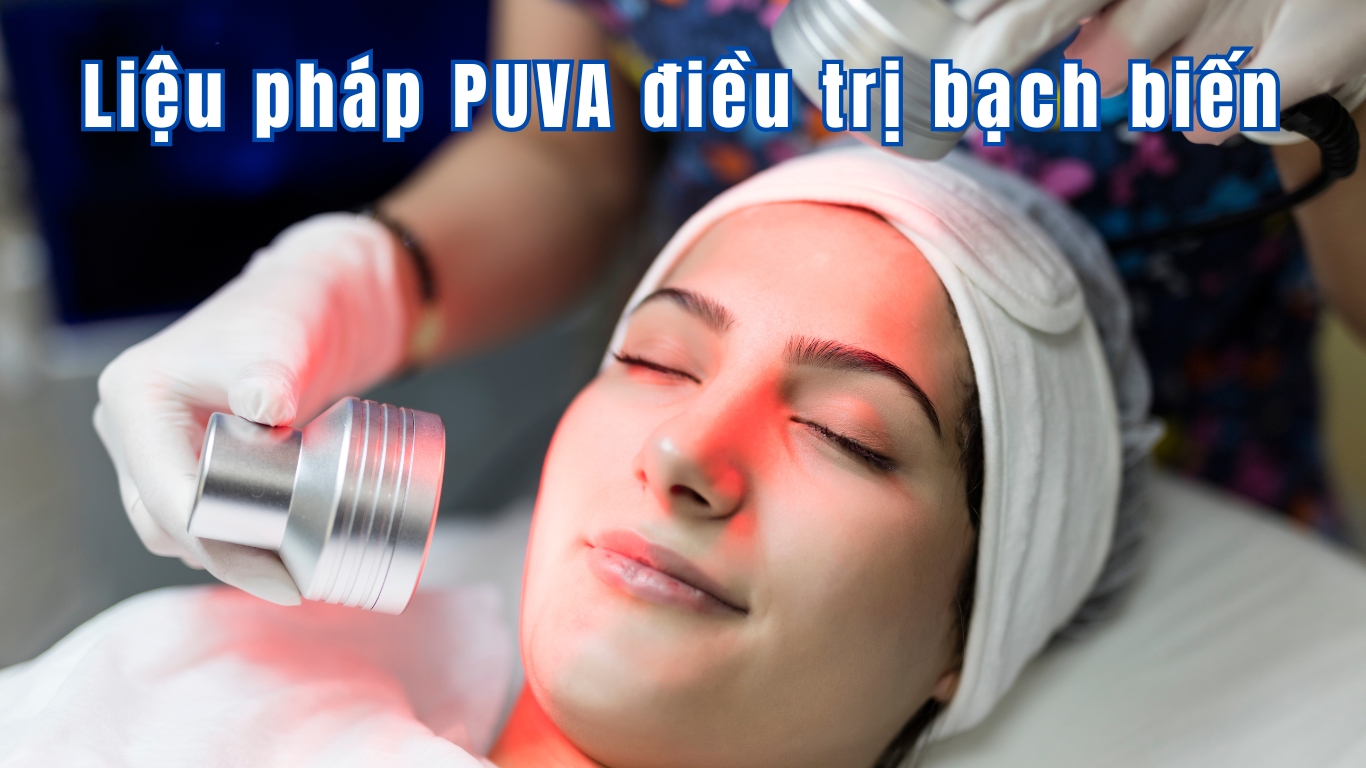 Liệu Pháp Ánh Sáng (PUVA/UVB): Giải Pháp Điều Trị Bạch Biến Hiệu Quả Liệu pháp PUVA điều trị bạch biến tại bệnh viện