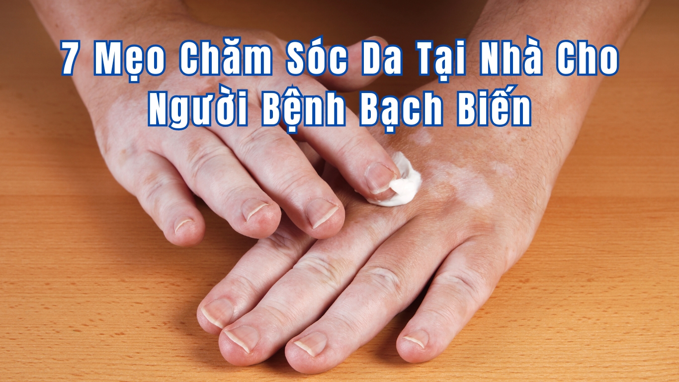 7 Mẹo Chăm Sóc Da Tại Nhà Cho Người Bệnh Bạch Biến