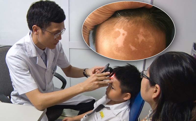 Bệnh Bạch Biến: Hướng Dẫn Toàn Diện Về Nguyên Nhân, Triệu Chứng và Các Phương Pháp Điều Trị Hiệu Quả Nhất 2025 Bệnh nhân tư vấn bác sĩ