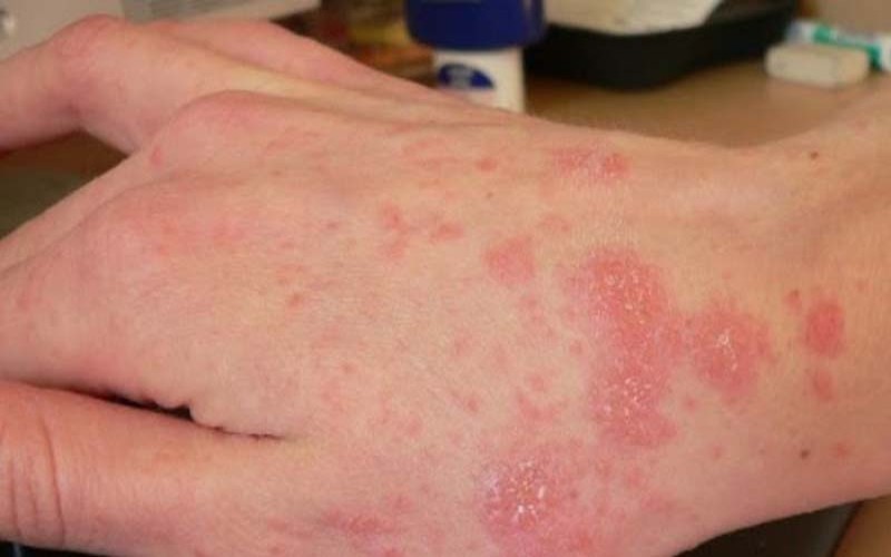 dau hieu viem da co dia nguoi lon 1