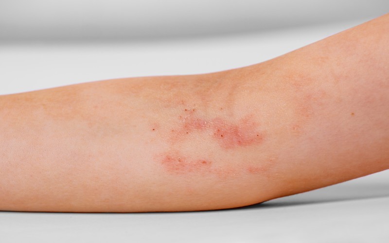 dau hieu viem da co dia