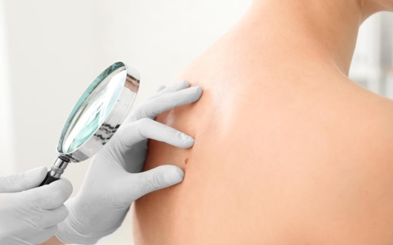 ung thu da giai doan dau 1