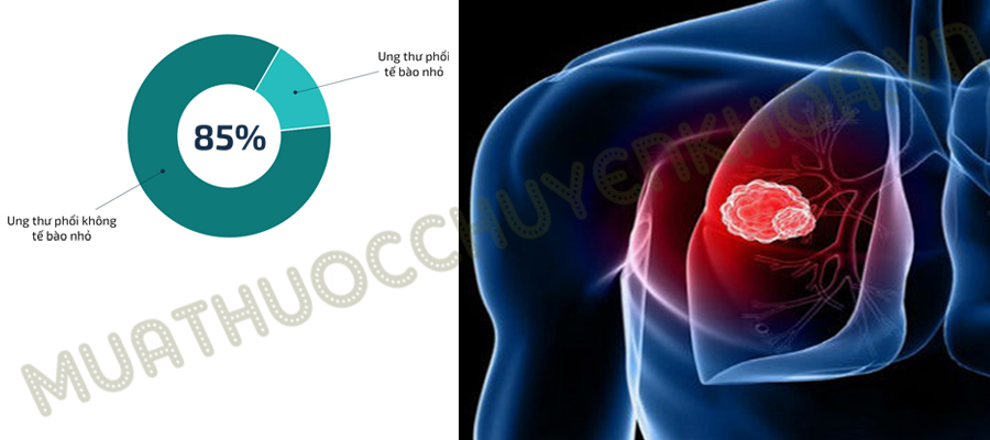 Ung Thu Phoi Khong Te Bao Nho
