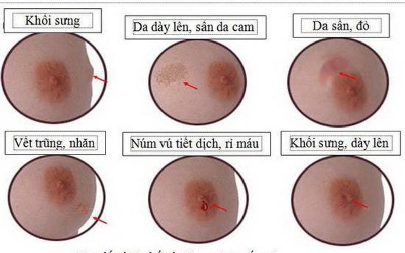 Top 7 Dấu Hiệu Nhận Biết Bệnh Ung Thư Vú Ở Nữ Giới cac dau hieu benh ung thu vu 1