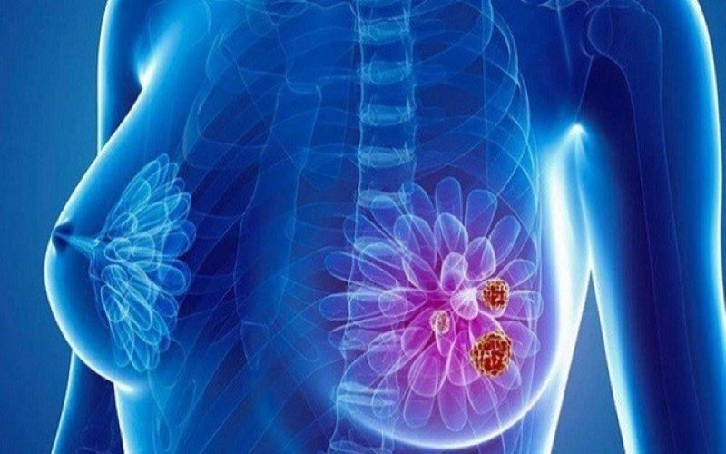 Top 7 Dấu Hiệu Nhận Biết Bệnh Ung Thư Vú Ở Nữ Giới ung thu vu 1 1