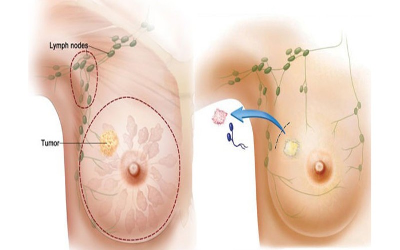 Bệnh Ung Thư Vú Giai Đoạn 1 Có Khỏi Được Không? ung thu vu 1