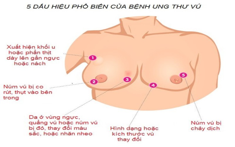 Bệnh Ung Thư Vú Giai Đoạn 1 Có Khỏi Được Không? ungthuvu11 1633147084065 1